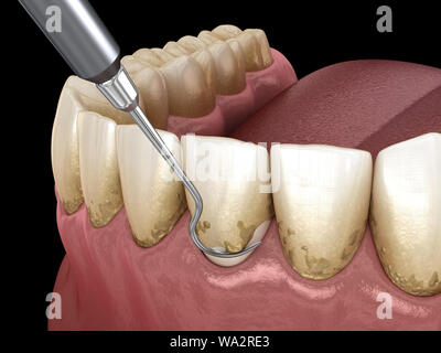 Igiene orale: Scaling e root (plananti convenzionali di terapia parodontale). Accurata dal punto di vista medico 3D illustrazione dei denti umani il trattamento Foto Stock