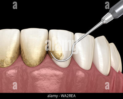 Igiene orale: Scaling e root (plananti convenzionali di terapia parodontale). Accurata dal punto di vista medico 3D illustrazione dei denti umani il trattamento Foto Stock