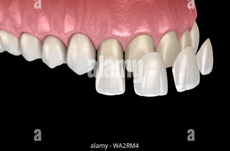 Impiallacciatura di procedura di installazione più incisivo centrale e incisivo laterale. Accurata dal punto di vista medico dente 3D illustrazione Foto Stock