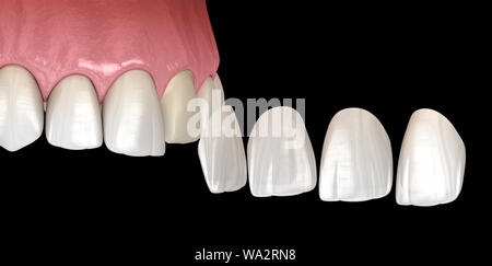 Impiallacciatura di procedura di installazione più incisivo centrale e incisivo laterale. Accurata dal punto di vista medico dente 3D illustrazione Foto Stock