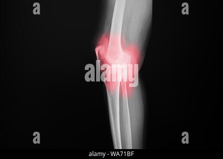 Film x-ray ginocchio osteoartrite del ginocchio del paziente e articolazione artificiale Foto Stock