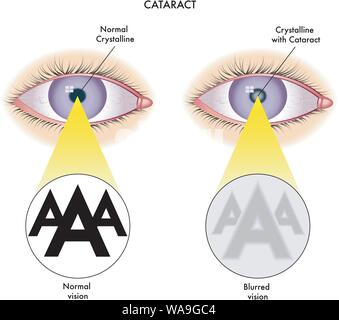 Illustrazione medica degli effetti di cataratta. Illustrazione Vettoriale