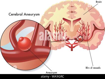 Illustrazione medica dei sintomi di aneurisma cerebrale. Illustrazione Vettoriale