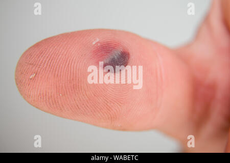 Blister di sangue sotto la pelle con il pollice. Giovani caucasici uomo dito su sfondo bianco Foto Stock