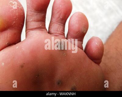 Malattia clavus nelle suole dei piedi Foto Stock