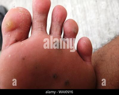 Malattia clavus nelle suole dei piedi Foto Stock