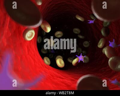 Malato di cellule del sangue, illustrazione del computer. Foto Stock