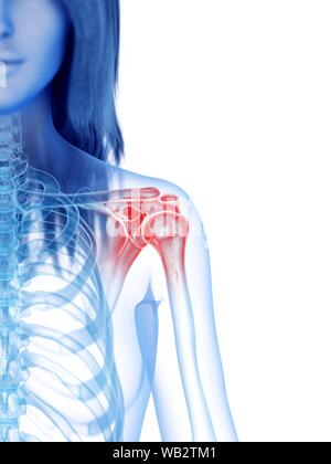 Dolore alla spalla, illustrazione concettuale Foto Stock