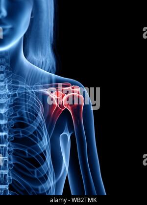 Dolore alla spalla, illustrazione concettuale Foto Stock