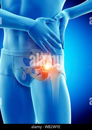 Hip dolore, illustrazione concettuale. Foto Stock