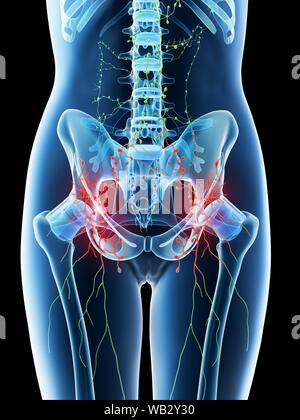 Ingrandito addominale linfonodi, concettuale illustrazione del computer. Foto Stock