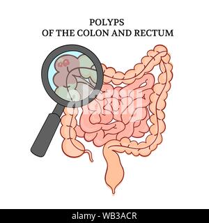 Polipi DEL COLON intestino medicina Anatomia Umana Schema Handdraw illustrazione vettoriale Illustrazione Vettoriale