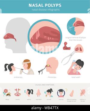 Malattie nasali. Polipi nasali provoca, la diagnosi e il trattamento medico design infografico. Illustrazione Vettoriale Illustrazione Vettoriale