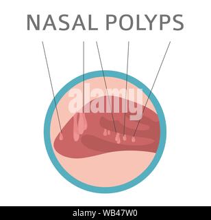 Malattie nasali. Polipi nasali provoca, la diagnosi e il trattamento medico design infografico. Illustrazione Vettoriale Illustrazione Vettoriale