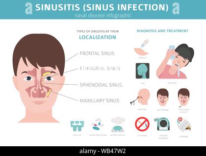 Malattie nasali. La sinusite, infezione sinusale la diagnosi e il trattamento medico design infografico. Illustrazione Vettoriale Illustrazione Vettoriale