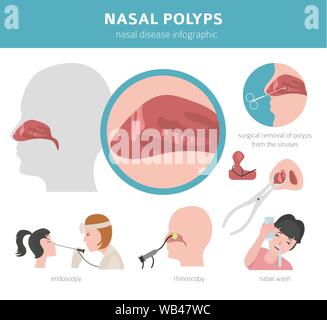 Malattie nasali. Polipi nasali provoca, la diagnosi e il trattamento medico design infografico. Illustrazione Vettoriale Illustrazione Vettoriale