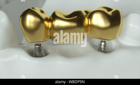 Impianti con golden ponte dentale - 3d rendering Foto Stock