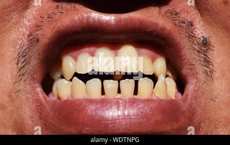 Chiudere - fino alla fila di denti con macchie di colore giallo e di distanza, Red Gums nella bocca degli uomini, dentale e salute orale dovrebbe essere mantenuto e trattati Foto Stock