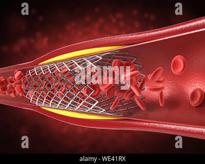 3D rendering procedura di angioplastica a pallone con lo stent in vena Foto Stock