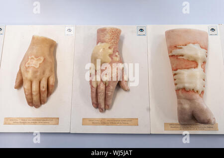 03 settembre 2019, Bassa Sassonia, Dethlingen: lesioni causate da agenti di guerra chimica sono stati simulati su una replica di una mano e avambraccio. Dopo la scoperta dei resti di agenti di guerra chimica nelle acque sotterranee nelle vicinanze Munster, il riempito Dethlinger stagno è di essere aperti dal 16 settembre. Nelle acque sotterranee, per esempio, la perdita di prodotti di degradazione, cioè gas mostarda, era stata trovata. Foto: Philipp Schulze/dpa Foto Stock