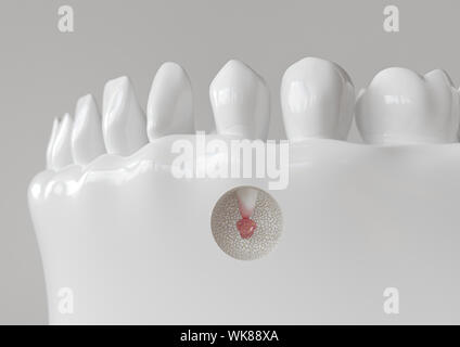 Punta di radice infiammazione con apicectomy - 3D rendering Foto Stock