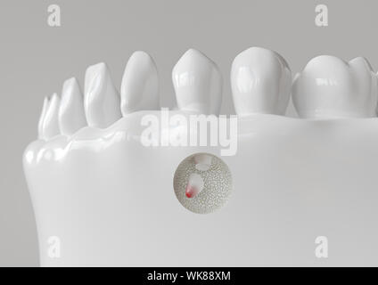 Punta di radice infiammazione con apicectomy - 3D rendering Foto Stock