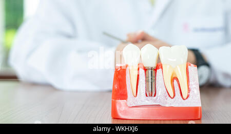 Impianto modello dentale in Dental Care concetto. Foto Stock