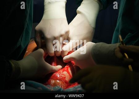 Lubin, Polonia. 31 ott 2009. Parto Cesareo in un 42-anno-vecchia ragazza. La procedura è stata completata con successo. Il principale nella foto è un ragazzo. È consuetudine quando una donna è al di sopra dei 40 anni per eseguire un taglio cesareo. Indicazioni mediche anche sostenere questa soluzione quando è necessario procedere rapidamente a salvare la vita della madre e del bambino Credito: Piotr Twardysko-Wierzbicki/ZUMA filo/Alamy Live News Foto Stock