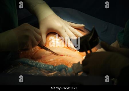 Lubin, Polonia. 31 ott 2009. Parto Cesareo in un 42-anno-vecchia ragazza. La procedura è stata completata con successo. Il principale nella foto è un ragazzo. È consuetudine quando una donna è al di sopra dei 40 anni per eseguire un taglio cesareo. Indicazioni mediche anche sostenere questa soluzione quando è necessario procedere rapidamente a salvare la vita della madre e del bambino Credito: Piotr Twardysko-Wierzbicki/ZUMA filo/Alamy Live News Foto Stock