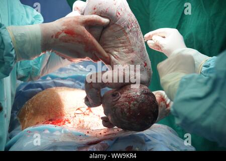 Lubin, Polonia. 31 ott 2009. Parto Cesareo in un 42-anno-vecchia ragazza. La procedura è stata completata con successo. Il principale nella foto è un ragazzo. È consuetudine quando una donna è al di sopra dei 40 anni per eseguire un taglio cesareo. Indicazioni mediche anche sostenere questa soluzione quando è necessario procedere rapidamente a salvare la vita della madre e del bambino Credito: Piotr Twardysko-Wierzbicki/ZUMA filo/Alamy Live News Foto Stock