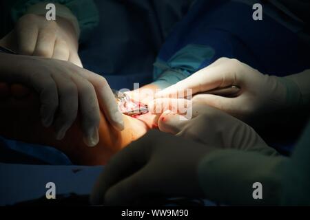 Lubin, Polonia. 31 ott 2009. Un 22-anno-vecchio uomo con lesioni della caviglia è andato all'ospedale per ortopedia. una frattura multipla la frattura è stato scoperto durante lo studio. In questo caso, un'operazione era necessario, che è stata un completo successo Credito: Piotr Twardysko-Wierzbicki/ZUMA filo/Alamy Live News Foto Stock