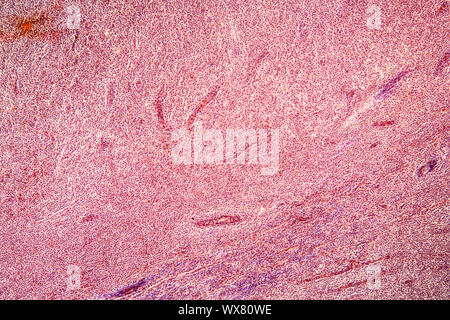 Tonsillite tessuto malato sotto il microscopio 100x Foto Stock