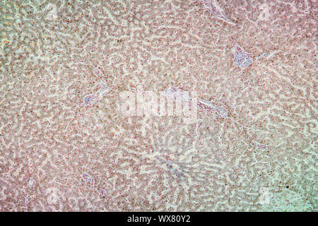 Emosiderosi del tessuto di fegato sotto il microscopio 100x Foto Stock