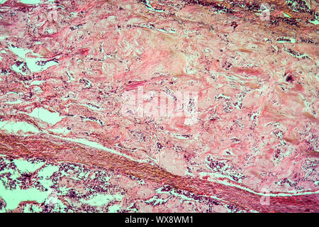 Tiroide carcinoma scirrhous tessuto malato 100x Foto Stock