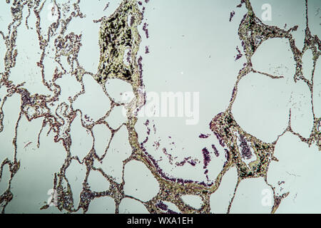 Polmone di tessuto umano sotto il microscopio 100x Foto Stock