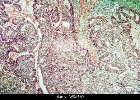 Il cancro del colon carcinoma emerso dall adenoma, 100x Foto Stock