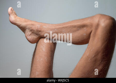 Grande placca parapsoriasi sull uomo caucasico gambe Foto Stock